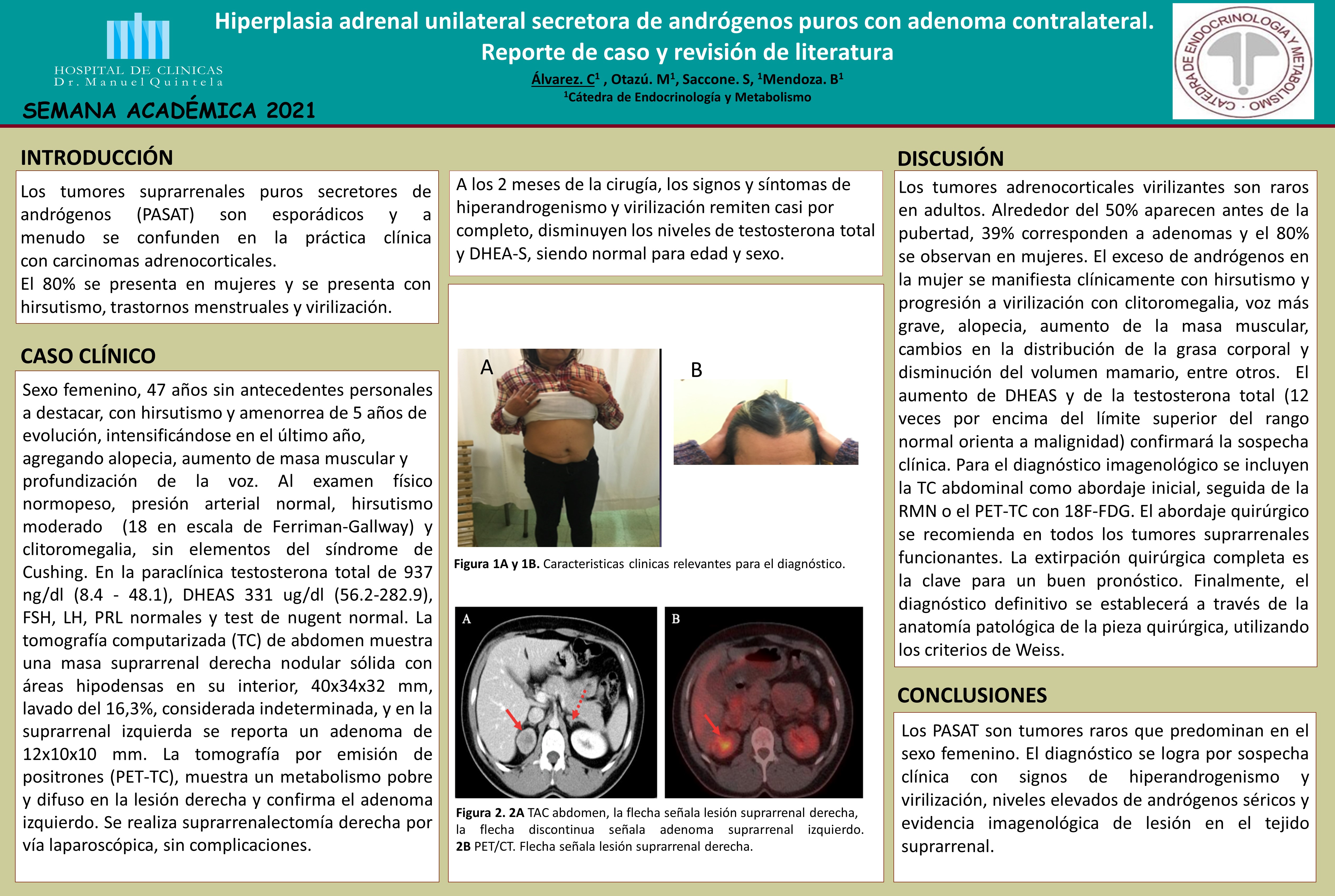 Hiperplasia adrenal unilateral secretora de andrógenos